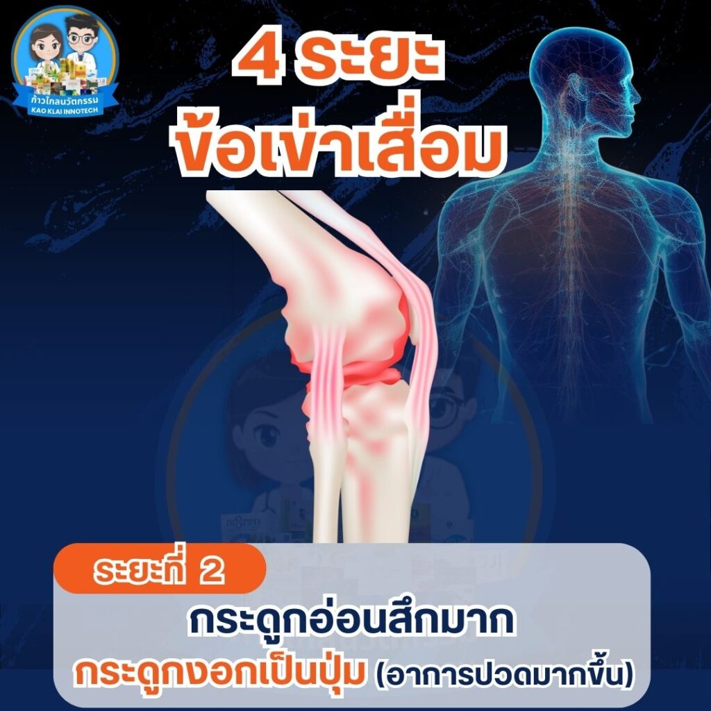 เข่าเสื่อม ปวดเข่า ปวดหัวเข่า (21)