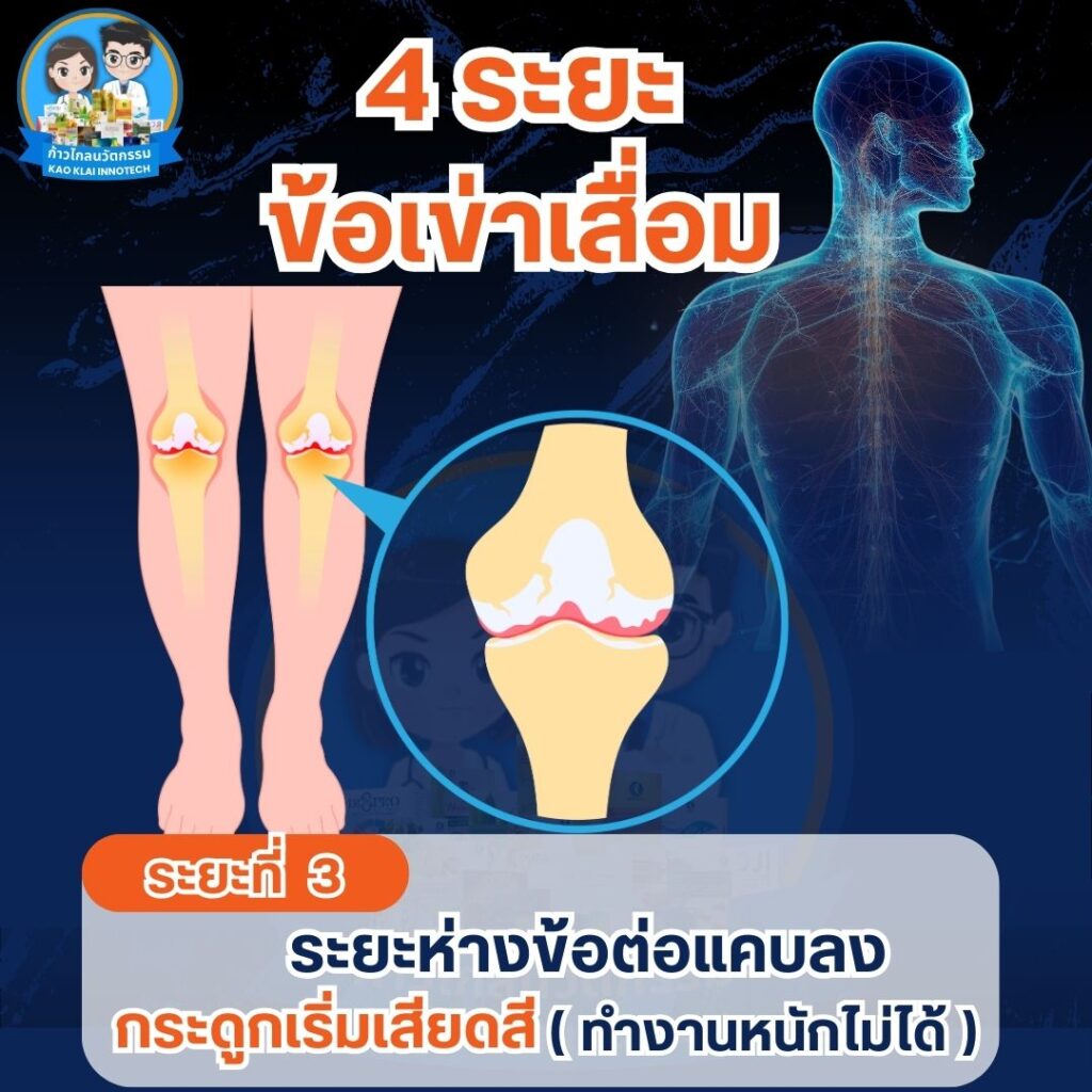 เข่าเสื่อม ปวดเข่า ปวดหัวเข่า (22)