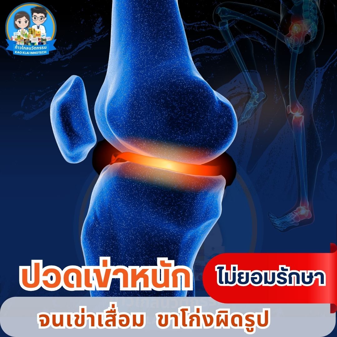 เข่าเสื่อม ปวดเข่า ปวดหัวเข่า