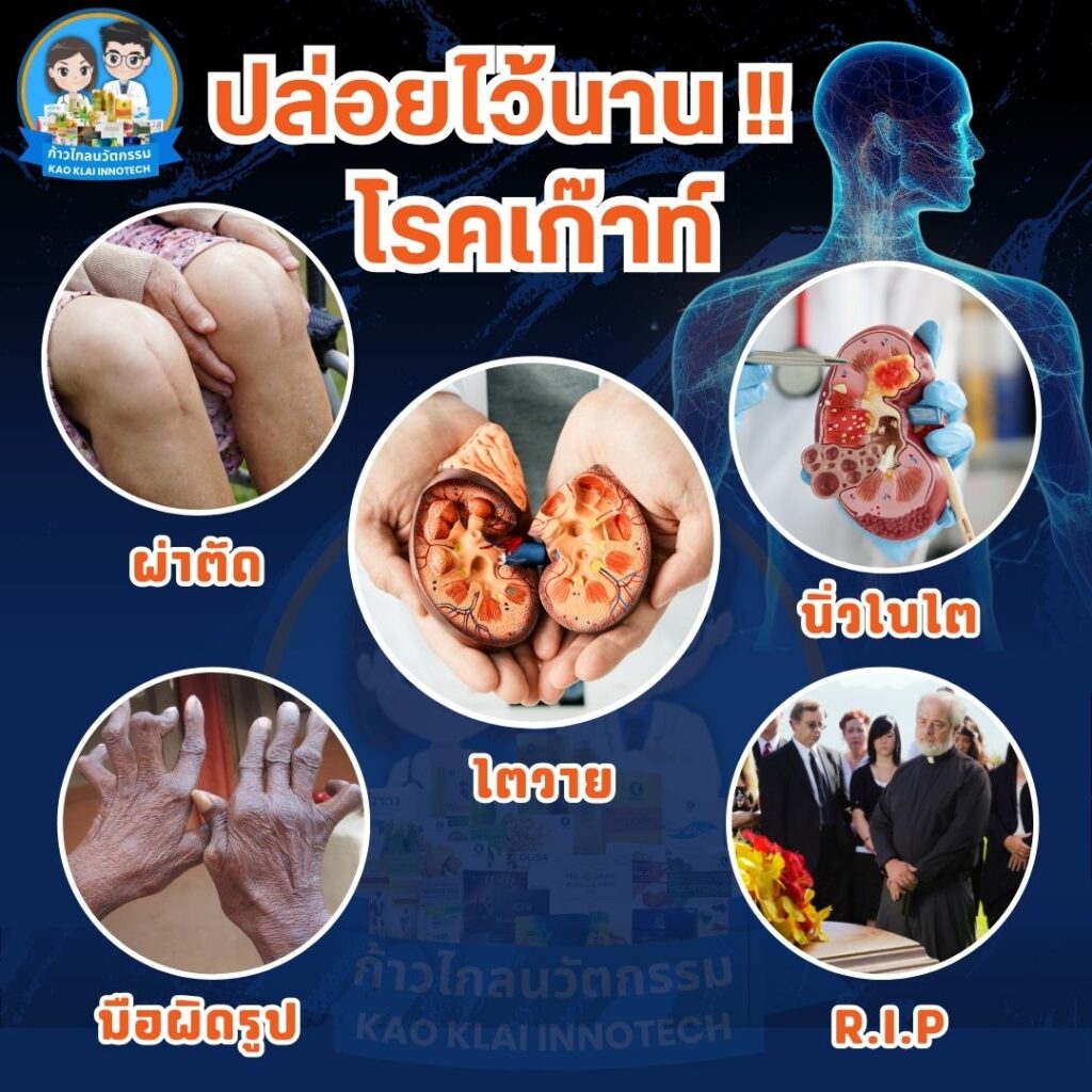 รูมาตอยด์ โรครูมาตอยด์ โรคเก๊าท์ ข้อเข่าเสื่อม (19)1