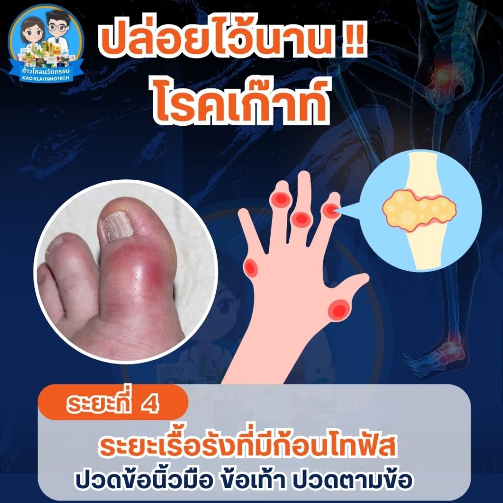 รูมาตอยด์ โรครูมาตอยด์ โรคเก๊าท์ ข้อเข่าเสื่อม (26)3