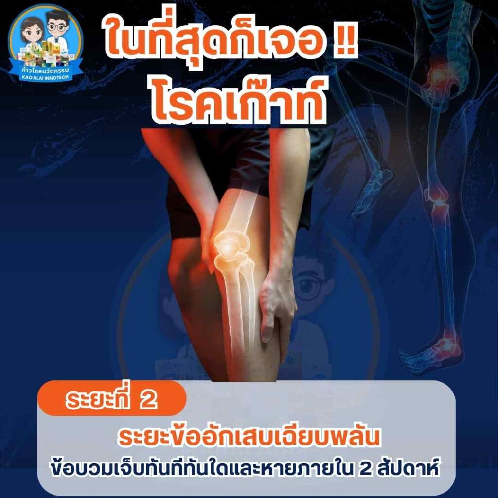 โรคเก๊าท์ ระยะที่ 2 ข้ออักเสบเฉียบพลัน ในที่สุดก็เจอโรคเกาต์ ข้อเข่าเสื่อม รูมาตอยด์ โรครูมาตอยด์